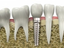 Maryville Dental Implants